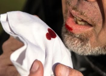 Penderita TB Capai 1.500 Orang, Dinkes Padang Bentuk Tim Penanggulangan Tuberkulosis