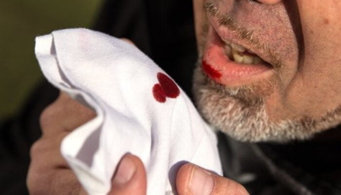 Penderita TB Capai 1.500 Orang, Dinkes Padang Bentuk Tim Penanggulangan Tuberkulosis