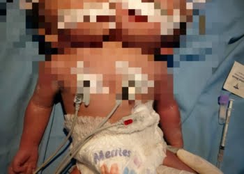 Sempat Kritis, Bayi Kembar Siam Dua Kepala Satu Badan Meninggal Dunia
