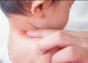 Sumbar KLB Campak, Imunisasi Anak Harus Ditingkatkan