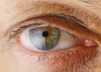 Memahami Pengertian Gangguan Penglihatan Katarak dan Pengobatannya