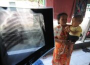 1.521 Balita di Sumbar Alami Pneumonia