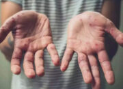 Antisipasi Cacar Monyet, Dinkes Padang Ingatkan Masyarakat Pola Hidup Sehat