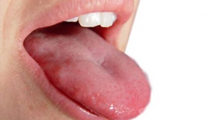 Lidah Terasa Pahit Bisa Jadi Tanda Liver Bermasalah