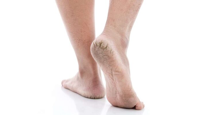 Cara Atasi Kulit Tumit dan Telapak Kaki Pecah-Pecah