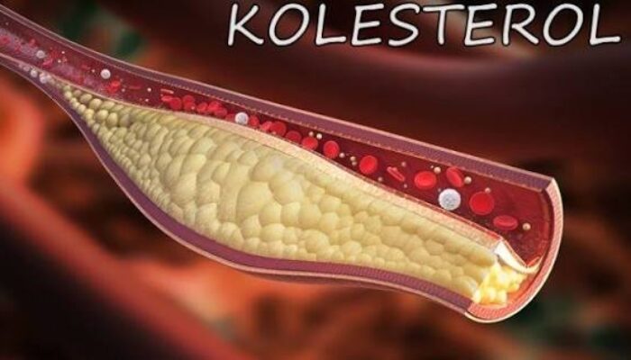 Inilah Beberapa Kebiasaan yang Menyebabkan Kolesterol Tinggi